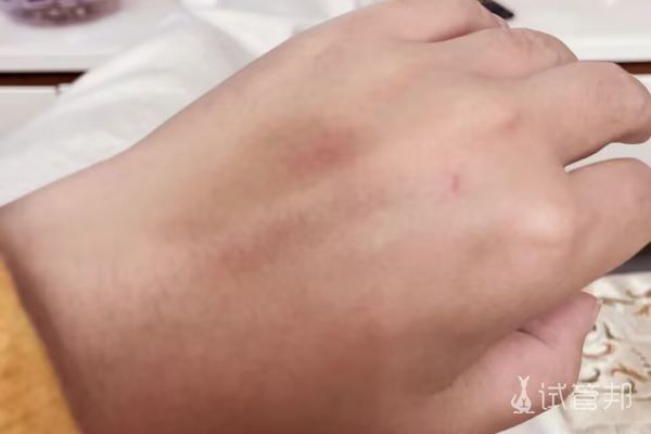 84334ea295e9dca040e2ca8ed023aaa3.jpg 试管婴儿成功取卵期待养囊结果