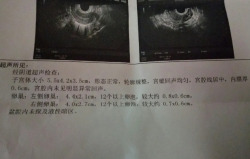 备孕2年无果，在川北医学院附属医院人工授精成功！