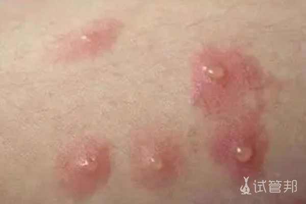 335f2f0eb1f1cec7c633556de1d6b28a.png 尖锐湿疣的早期症状图片