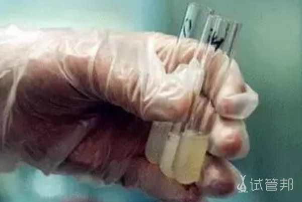 9918f67531575784b304527e93a8b6ee.png 梗阻性无精症是什么原因造成的