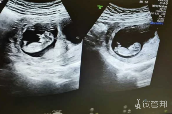 0da3504698ee56a18732e9278b35033f.png 试管双胞胎是什么感受