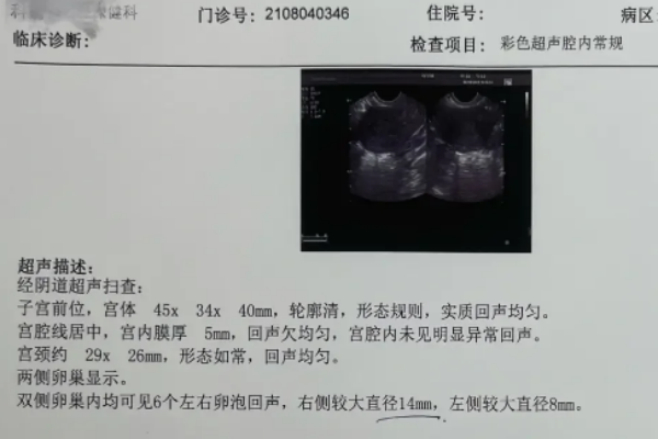 看卵泡监测的B超单的3个重点要牢记