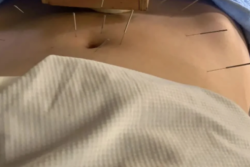 黔东南州中医医院试管婴儿经历：针灸真的能帮助着床
