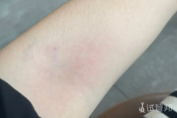 6a681809fe613c95052147a9bb3aa420.png 糖类抗原199检查指标回落放心了