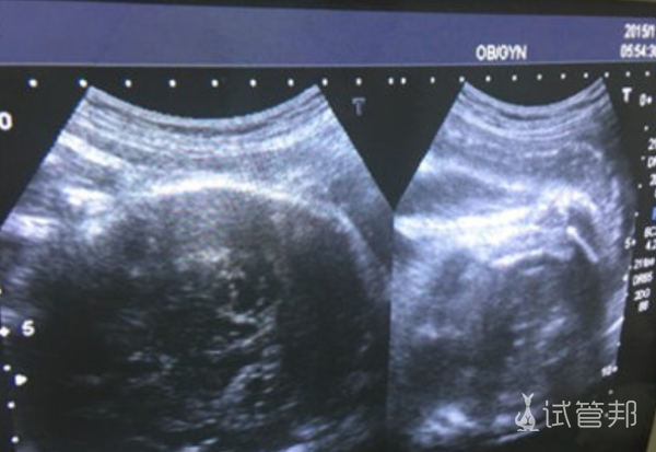 24周孕中期大排畸查出宝宝兔唇