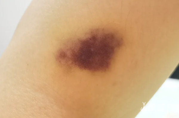 209c10831985da04c14c78959f42590c.png 多囊卵巢综合征加宫外孕最终决定尝试试管婴儿