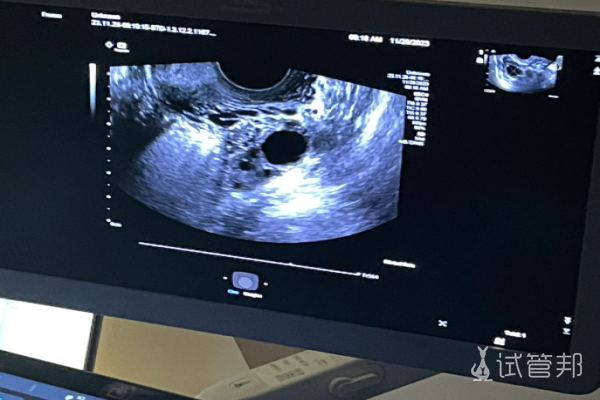 808c1a792b53a434b71e15722a06afee.png 大姨妈来后进入人授周期但却失败了