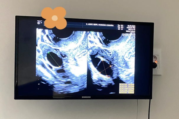 84862cac44baf69c3df0d6351248eabd.png 2促一移试管成功超详细费用明细来了