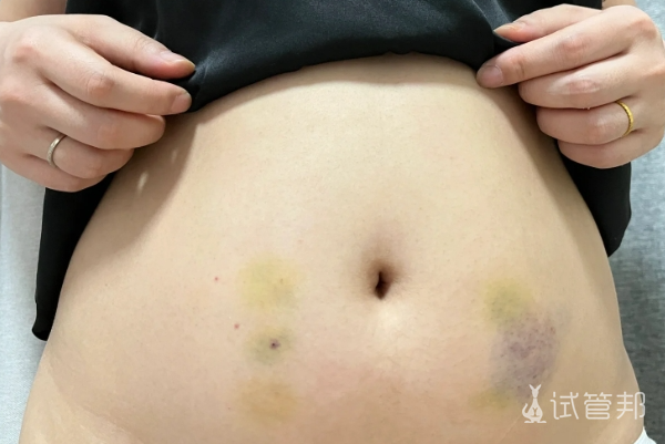 1cb421db6f56383b84c8d4a54eb09238.png 我的三代试管之路取卵经历分享