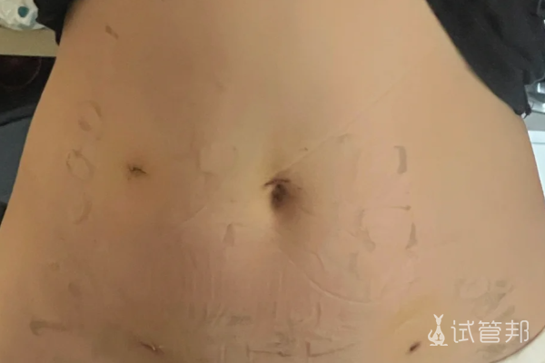 a44efd326b5c47817e3f077bd623d34d.png 巧克力囊肿腹腔手术感谢医生给开的刀口这么小