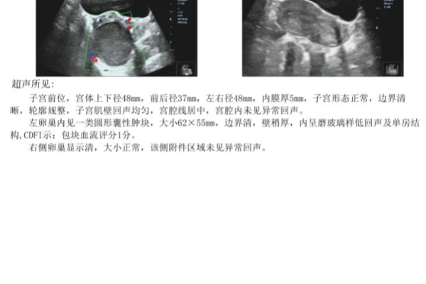 巧克力囊肿趁早治疗