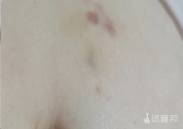 a194e1717d7e28aa873feea5932c4bb9.png 人工授精经历中的一次意外