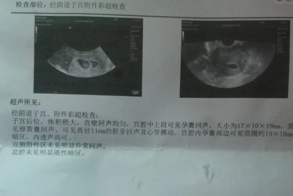 罕见病夫妻的三代试管婴儿日记之胚胎筛查结果全军覆没