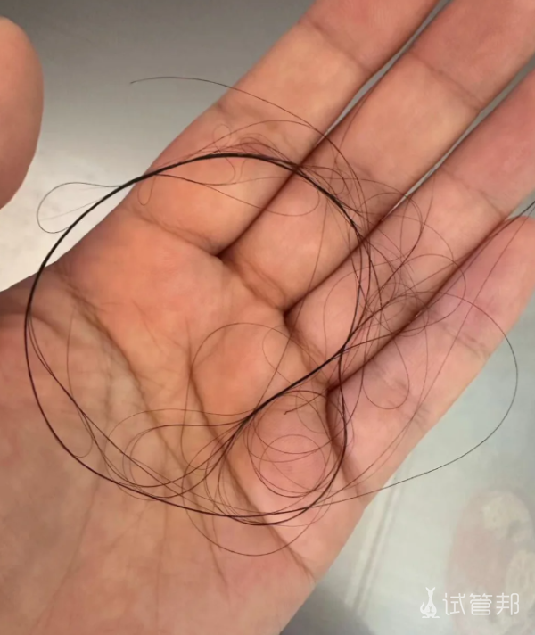 95336c96bedfe05f3c156d78b4a65721.png 做试管婴儿会导致脱发吗