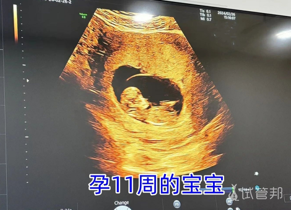 440ea4133f924b1f3ae242e15513eedd.png 44岁高龄一取一移喜提好孕