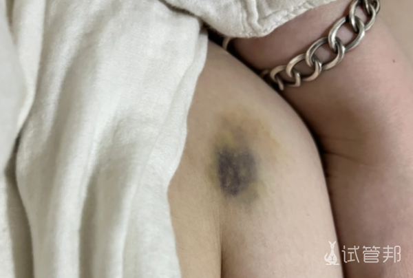 5884bfdce38c15f49989b0936dfee55b.png 喜提夜针啦我的促排第14天的夜针经历