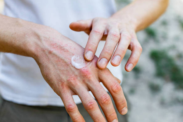 1ebbcf4ba24d72d8fe16e6fb5e20660c.png 银屑病会导致关节痛吗