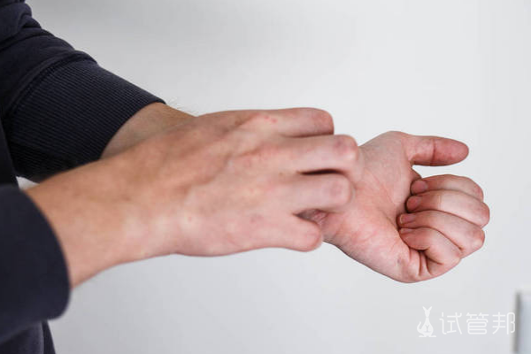 a6716e4f67804527534344c56391d3b0.png 银屑病有传染性吗