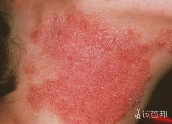 f1d2518295c0c780350a2ff8bca34129.png 系统性红斑狼疮传染吗