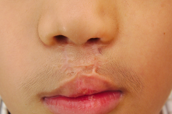 4a7a7e67d88b50c2a4c982b15b788e8c.png 唇腭裂二期修复有必要吗