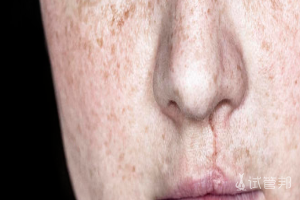 504a29c906345bbb3cf0168e90793bed.png 唇腭裂修复整形几次有效果