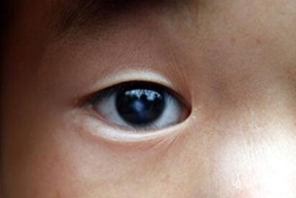 7d973a87abe219baa5e207bf8e615433.png 先天性白内障是什么意思