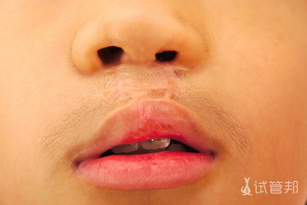 84f066ae862022fe10d16ac9e7b41c9a.png 唇腭裂手术痛吗