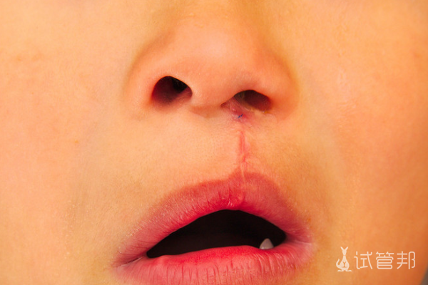 a16b73293955fcd622ea41a1d730a13c.png 唇腭裂手术费用能不能医保报销