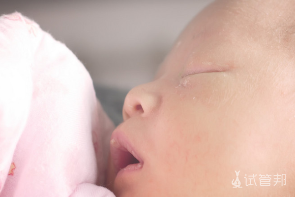 b195a4673b7c55979f751db5708aa135.png 苯丙酮尿症是什么疾病