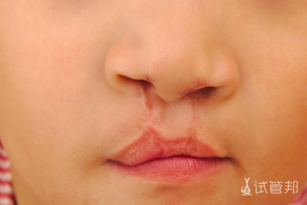 c007ac58b5e85999a09fc00ea4241086.png 唇腭裂手术费用需要多少