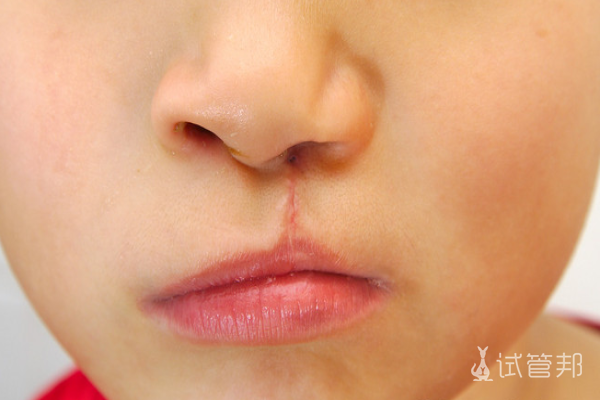 d12590061021509eff849012044c2e89.png 唇腭裂有哪些症状表现