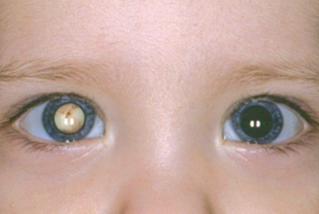 2d1ce529098427b0c5b1bb0a6868c2b3.png 先天性点状白内障会扩大吗