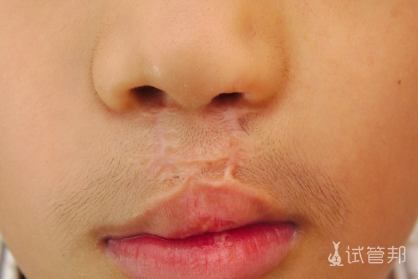 3a33629b0efe679c66550b971ea42911.png 先天性唇腭裂具体表现是怎样的