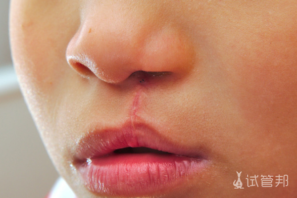 3bfa5315ee06b8c47afd56dcb53af4bf.png 先天性唇腭裂可不可以办理残疾证