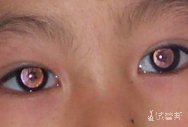5e9ee7f1aa9a21e7eefbf7c14932707e.png 儿童先天性白内障怎么引起的