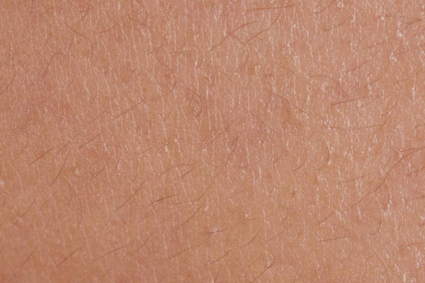 2be0ed5348c30dd6faea4076a9a9171f.png 鱼鳞病能不能治愈