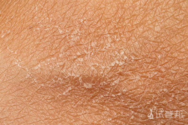 2e7fb7b598735542c2fd49e4f6d22879.png 鱼鳞病出现的原因有哪些