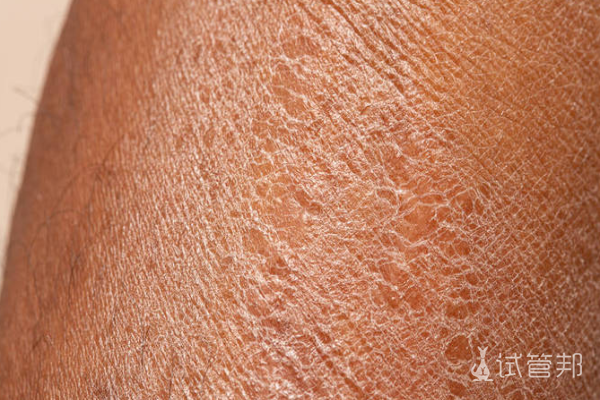 35c99207be7b0ac3f64bfcd767c0d8b1.png 鱼鳞病能不能恢复成正常人