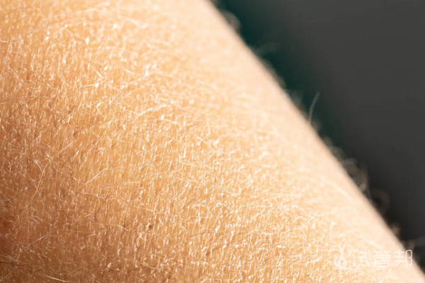 5a7316032f8bbbf9f7fbff47d0fb0e41.png 鱼鳞病要紧吗