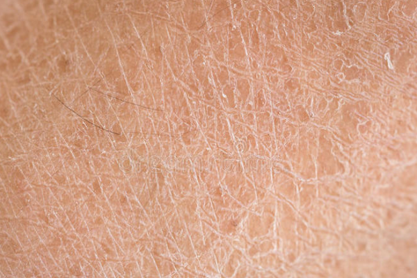 7892213a965c6cf75e1eac5ca3a46466.png 鱼鳞病是什么意思