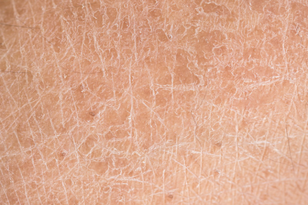 99515012b321a8ded68f35db2352a19d.png 鱼鳞病擦药能治好吗