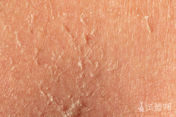 a20e43c0c016b3add622eb12a711a57b.png 鱼鳞病会遗传给几代人