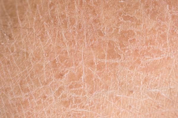 f70a0b25658fd36e44e5123f78555c15.png 鱼鳞病有哪些症状