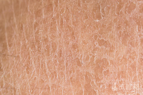 055c4650169f1e1235dbbb12d7d2b035.png 鱼鳞病用什么药膏好