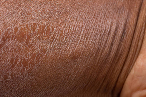 06ff758f821f1c9ada0efc48f4d3b2fb.png 鱼鳞病的遗传特性是怎样的