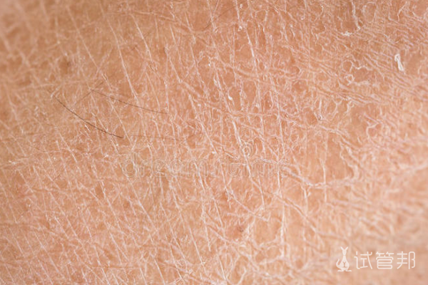 0d71437a02f03e184585dca385e7c9cb.png 先天性鱼鳞病会影响生育吗