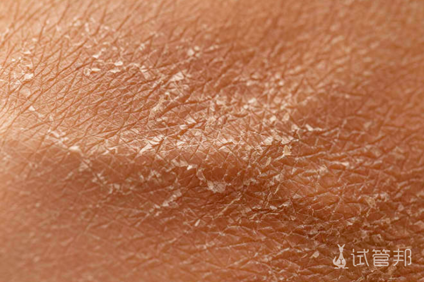 1b29eee5a5b376f3b30758744f18e8d0.png 鱼鳞病是不是银屑病