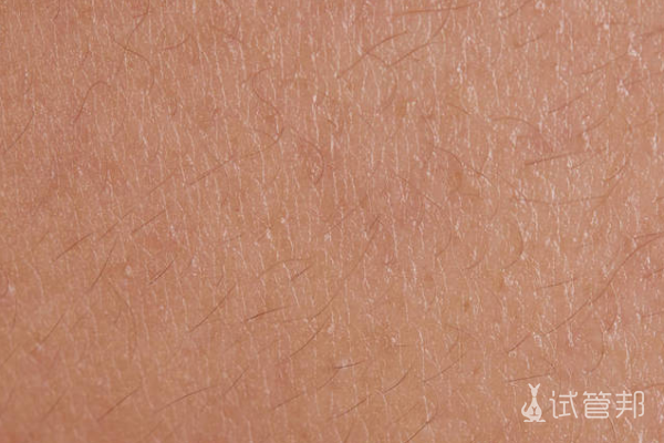 3d0fd64bec0122d3d9bdca5c4abc7529.png 鱼鳞病有哪些症状表现