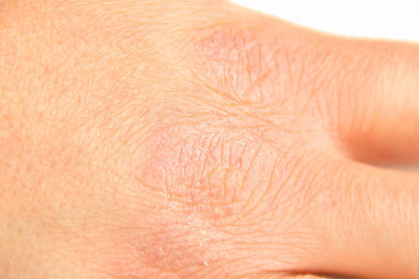 4e4c0e3885a45f8b04f6688871f09cdd.png 鱼鳞病是什么意思