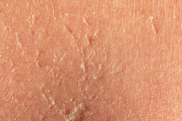 4fb27b22776a91a8cb9cec0db7fda5b3.png 鱼鳞病有什么表现